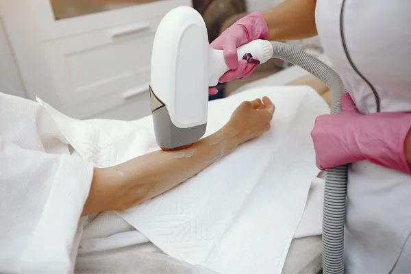 Laser Hair Removal for Sensitive Areas
