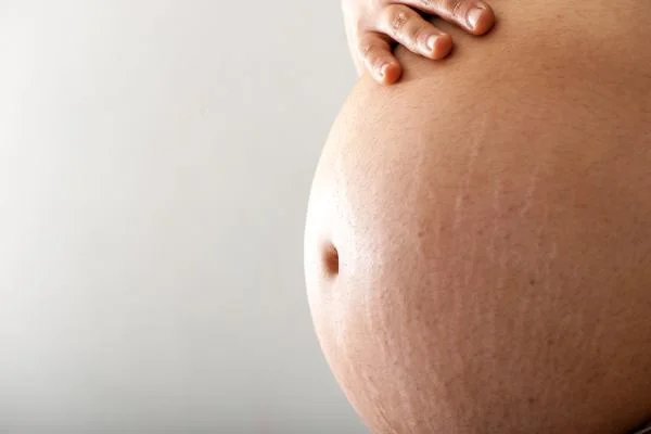 How to Reduce the Appearance of Stretch Marks During Pregnancy