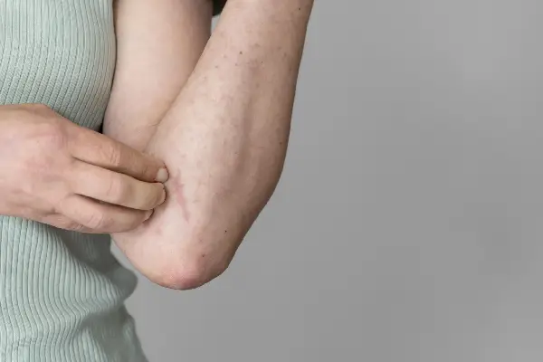 Diabetes and Skin Rash- What's the link?