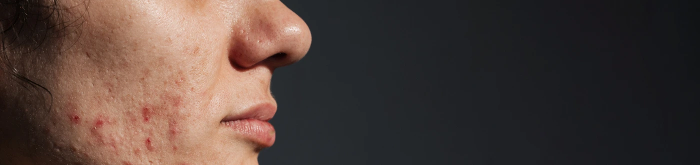 Acne Scarring Prevention