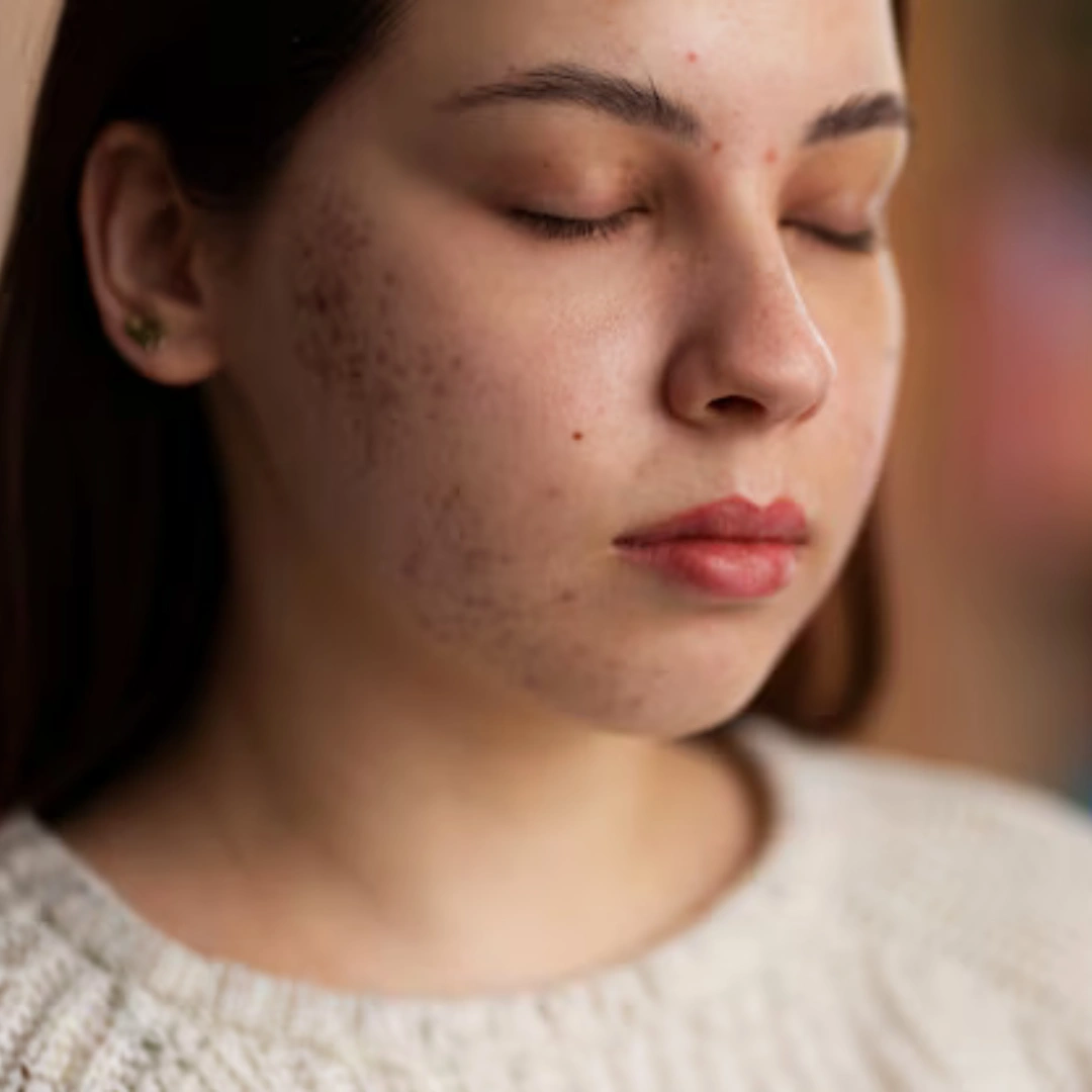 pigmentation treatment 