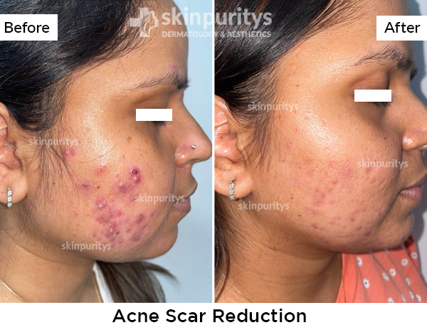 Acne Scars Reduction