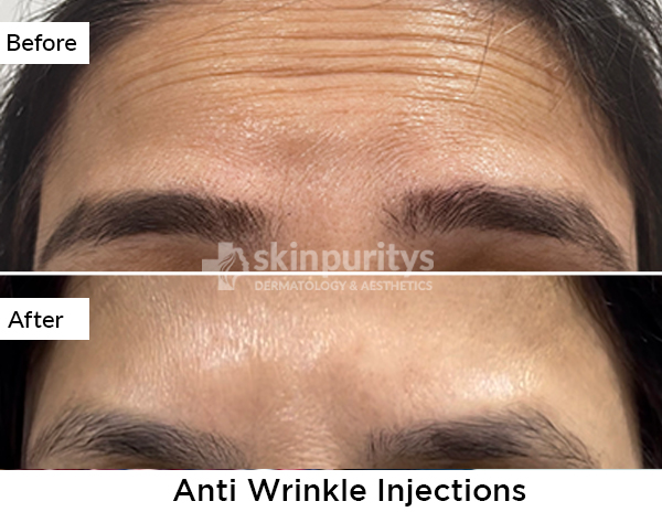 Acne Scars Reduction