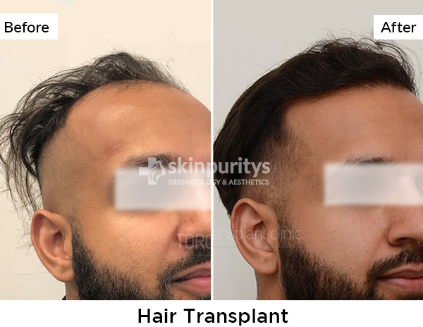 Acne Scars Reduction