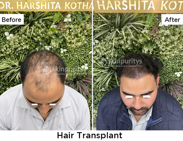 Acne Scars Reduction