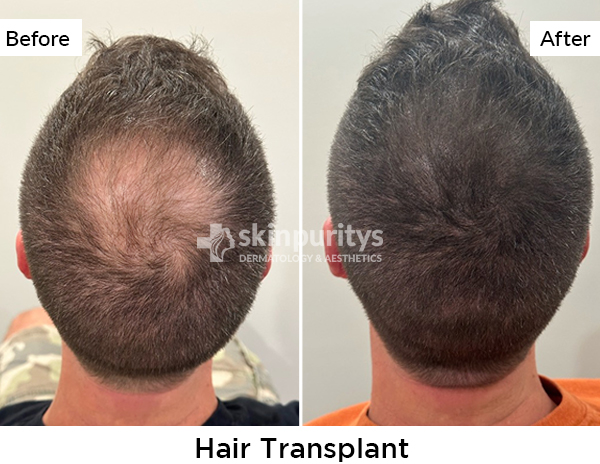 Hair Transplant