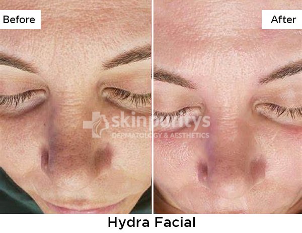 Hydrafacial Treatment results