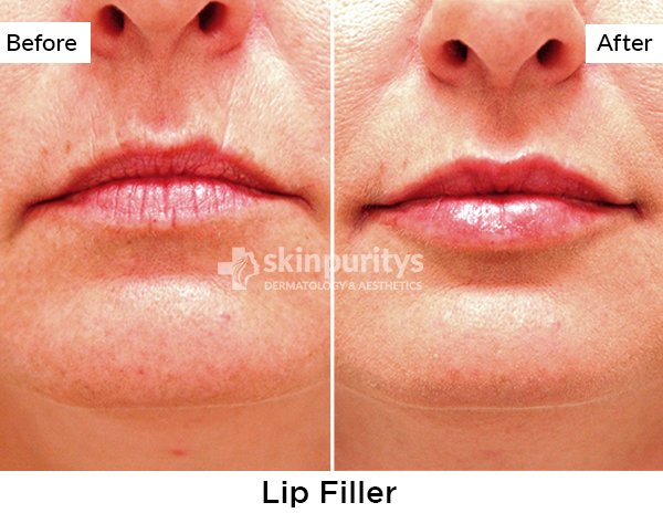 Lip Filler Treatment results