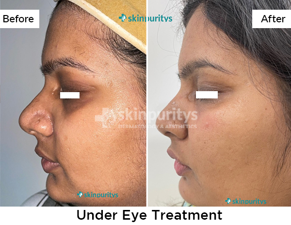 Under Eye Rejuvenation