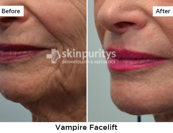 Vampire Facelift results