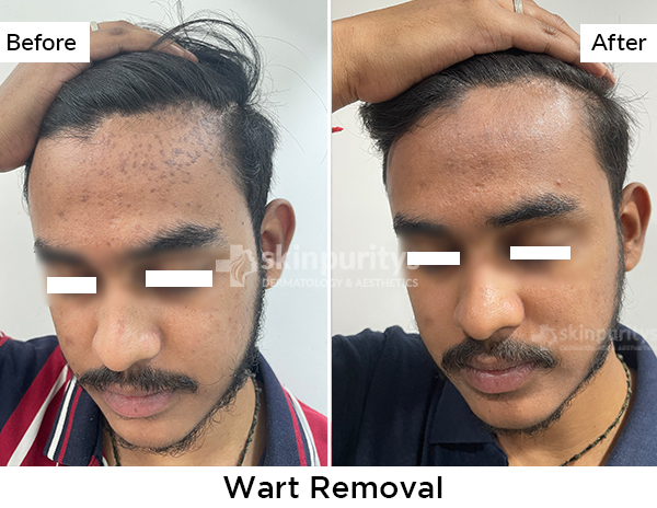 Wart Removal