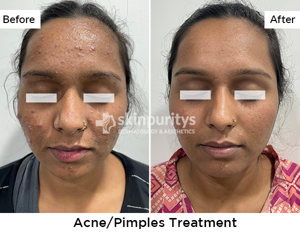 Acne Scars Reduction