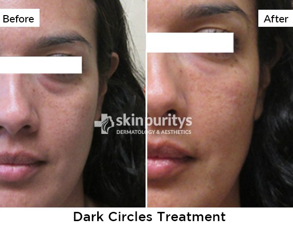 Dark Circles Treatment results