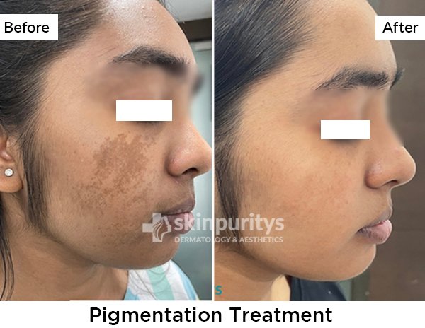 Pigmentation Treatment results