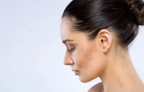 Melasma Treatment