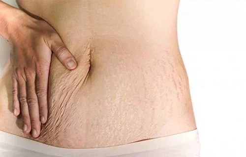 Stretch Marks Treatment
