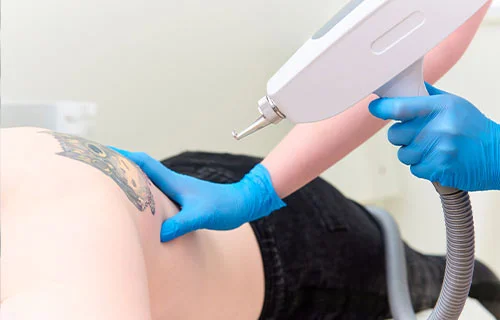 Laser Tattoo Removal Treatment