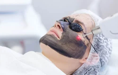 Carbon Laser Peel Treatment