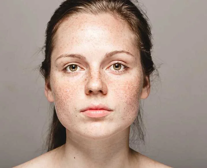 Signs of Hyperpigmentation: Identifying Dark Skin Patches and Spots