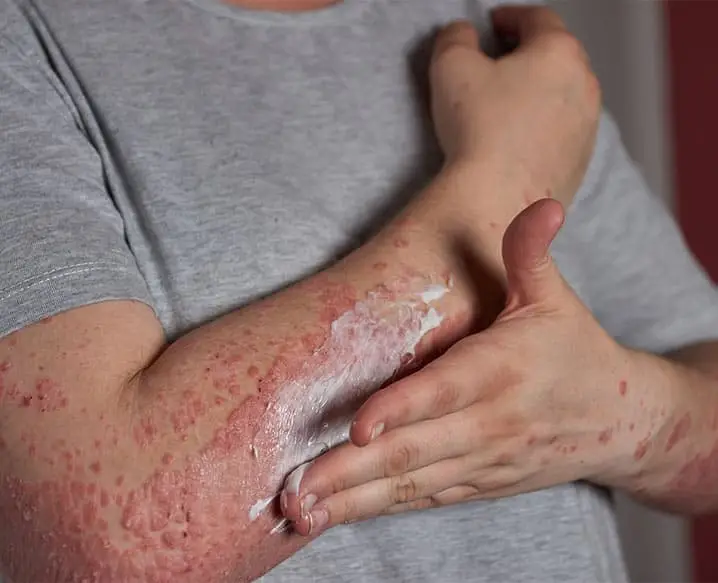eczema treatment: healing the affected skin and preventing its symptoms from a flare-up.