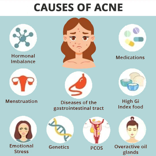 Causes Acne / Pimples: Hormonal Imbalance, Medications, Menstruation, PCOS, Emotional Stress, Overactive Oil Glands and more.