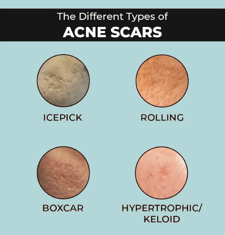 Types of Acne Scars: Icepick, Rolling, Boxcar, Hypertrophic/Keloid. Types of Acne Scar Treatment: Subcision, Chemical Peel