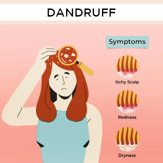 Signs and Symptoms of Dandruff: Itchy Scalp, Redness, Dryness