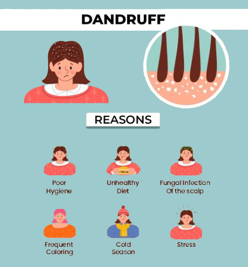 Causes of Dandruff: Poor Hygiene, Unhealthy Diet, Stress, Frequent Coloring, Cold Season, and Fungal Infection of the scalp.
